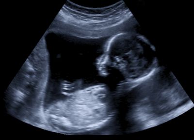 Ultrasound image